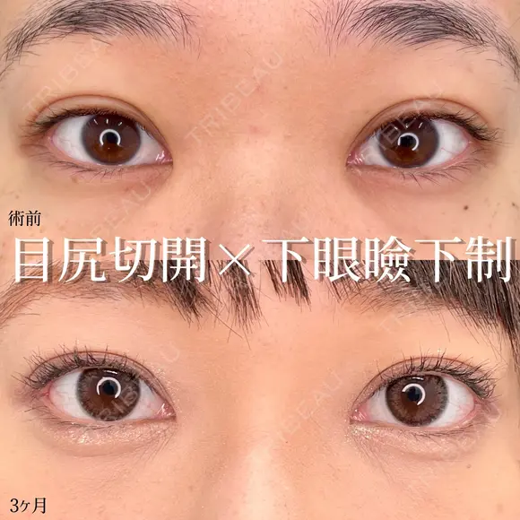 MD式目尻切開＋MD式下眼瞼下制（結膜切開） 90日後 メイン用