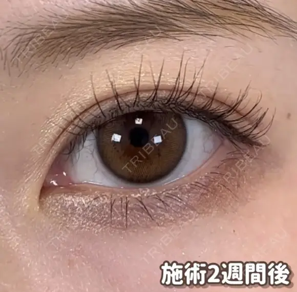 BELINDA二重術 after画像 メイン用