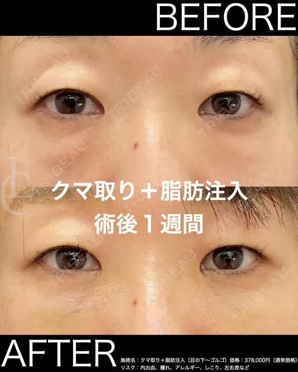 人気のクマ取り＋脂肪注入 before画像 メイン用