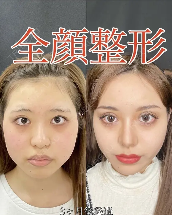 オペし放題モニター 90日後 メイン用