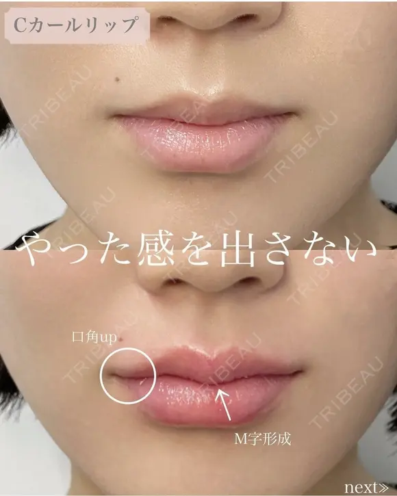 Cカールリップ(ヒアルロン酸注入) after画像 メイン用