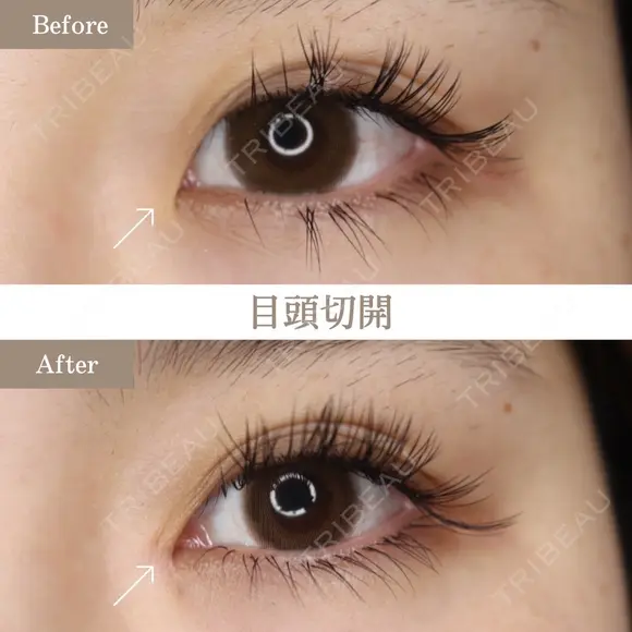 目頭切開 before画像 メイン用