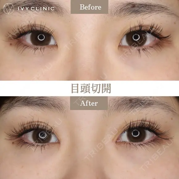 目頭切開 after画像 メイン用