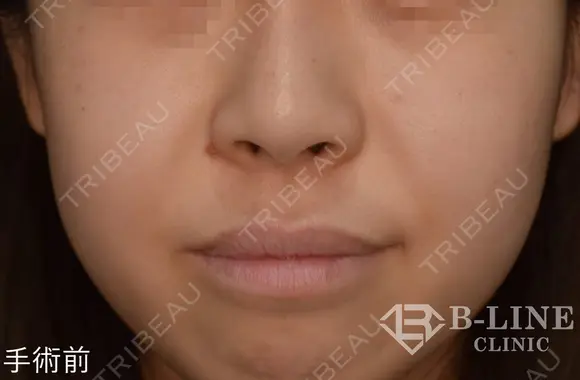 【小鼻縮小術】1ヶ月後 before画像 メイン用