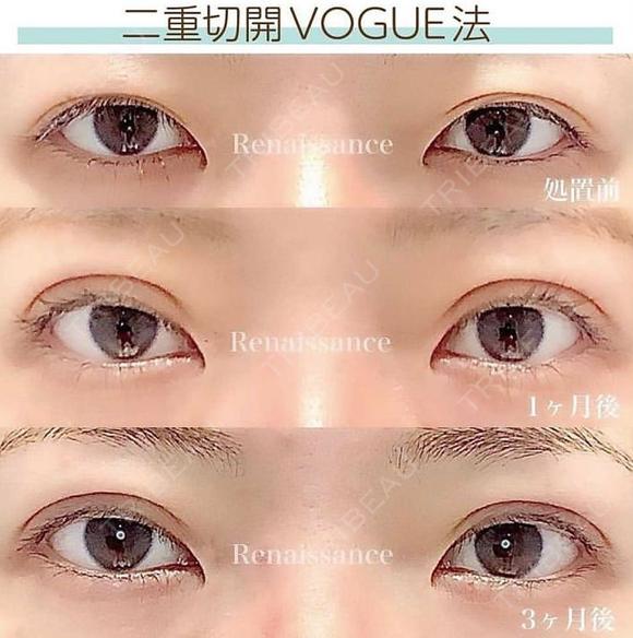 華やかで永続的な二重に💖二重切開VOGUE法 after画像 メイン用