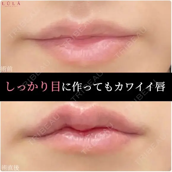 Cカールリップ 0日後 メイン用