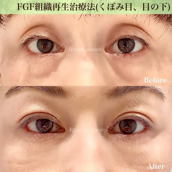 半永久的✨シワ改善（成長因子注入）くぼみ目 before画像 メイン用