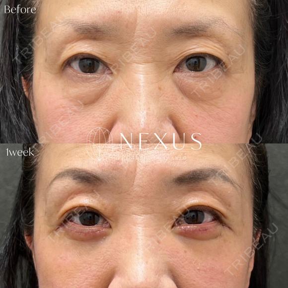 切開ハムラ法＋脂肪注入 after画像 メイン用