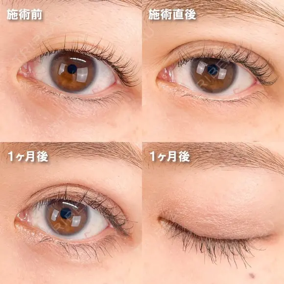 二重埋没法 before画像 メイン用