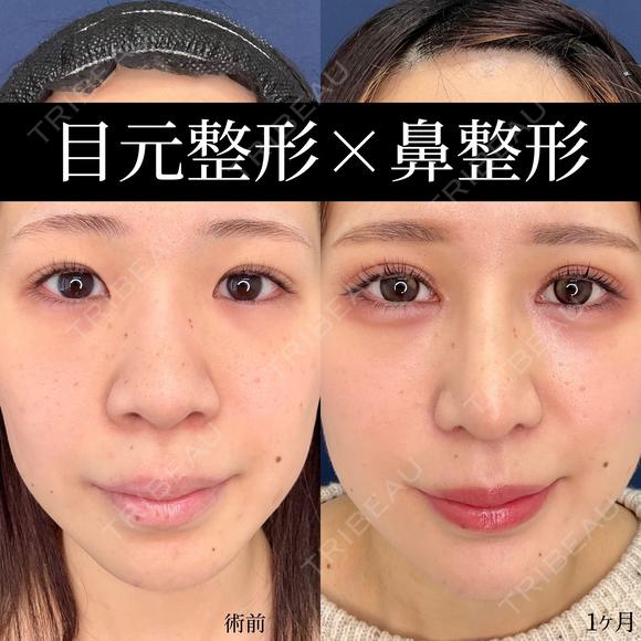 MD式たるみ取り併用全切開二重術、MD式目頭切開、涙袋ヒアルロン酸、プロテーゼ、鼻尖形成３D法、軟骨移植、小鼻縮小内外側法 before画像 メイン用