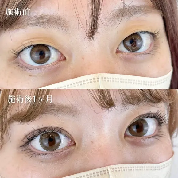 二重埋没法 before画像 メイン用