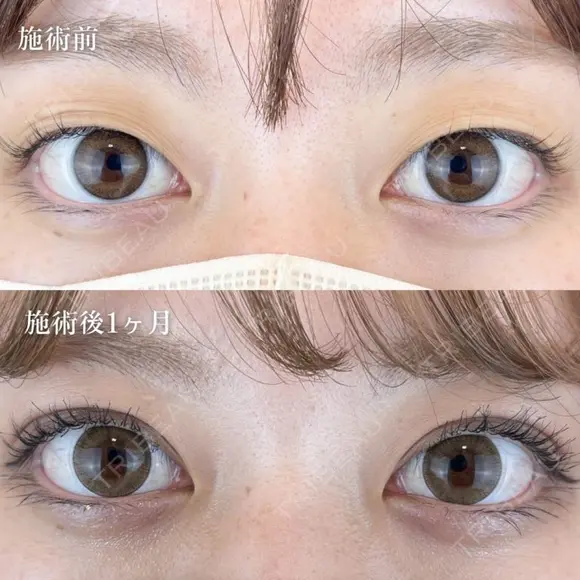二重埋没法 after画像 メイン用