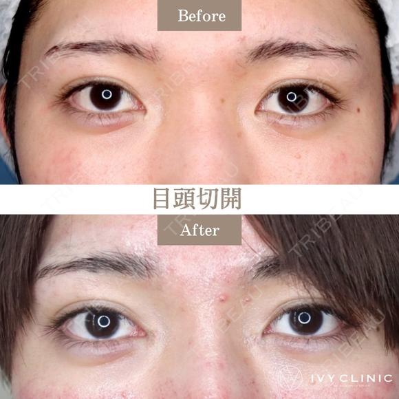 目頭切開 after画像 メイン用