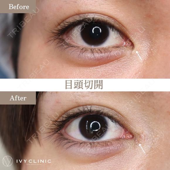 目頭切開 before画像 メイン用