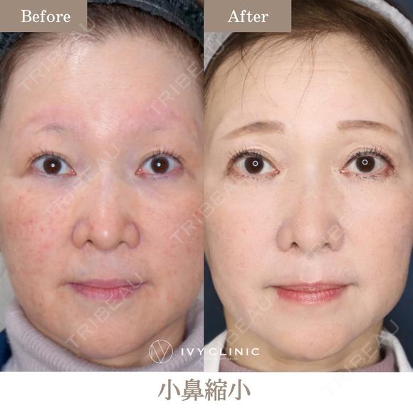 小鼻縮小(鼻翼縮小切開法) before画像 メイン用