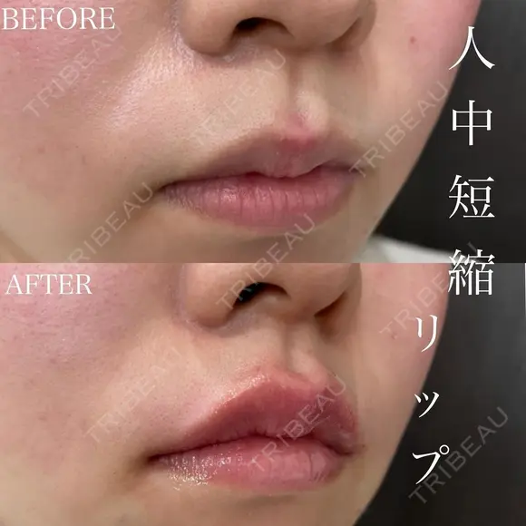 Cカールリップ｜M字の唇＋人中短縮効果 after画像 メイン用