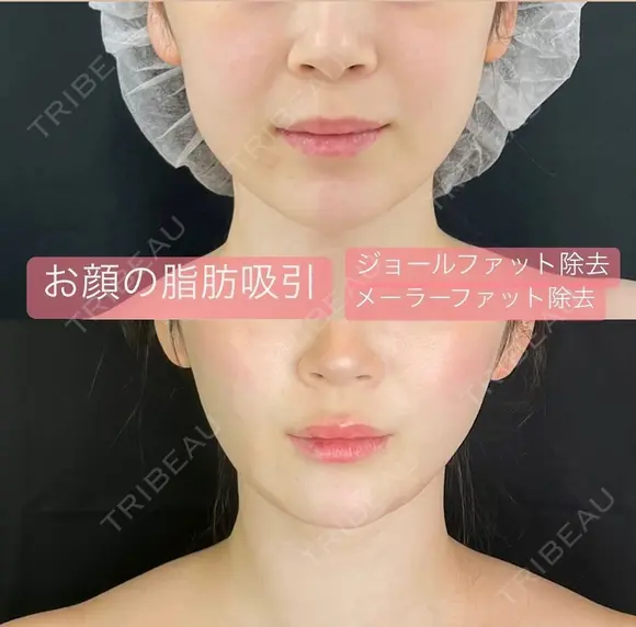 顔の脂肪吸引（ジョールファット・メーラーファット除去） after画像 メイン用