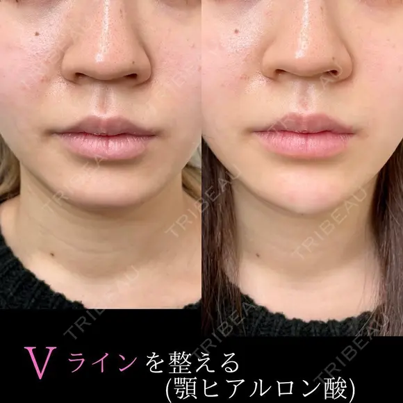 顎ヒアルロン酸注入｜Vラインを整える before画像 メイン用
