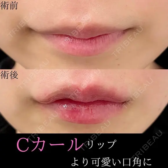 Cカールリップ｜より可愛い口角に💋 before画像 メイン用
