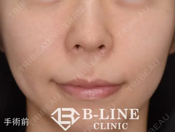 【人中短縮手術+小鼻縮小術】1ヶ月後 before画像 メイン用