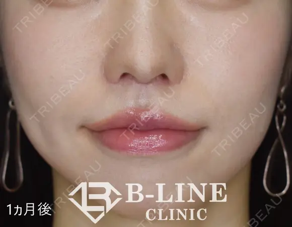 【人中短縮手術+小鼻縮小術】1ヶ月後 after画像 メイン用
