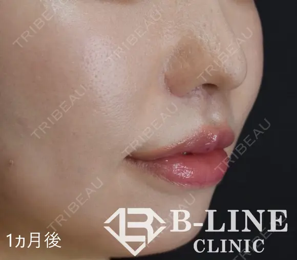 【人中短縮手術+小鼻縮小術】1ヶ月後 after画像 メイン用