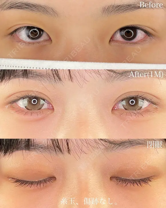 二重埋没法(エターナル二重術) before画像 メイン用