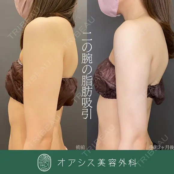 脂肪吸引（二の腕）600cc before画像 メイン用