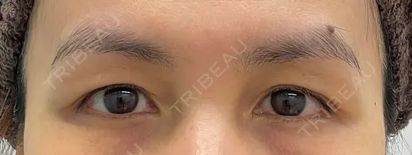 二重埋没 before画像 メイン用