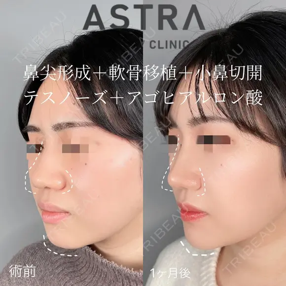 【大変身】隆鼻術・鼻尖形成・軟骨移植・小鼻切開・ヒアルロン酸（顎） after画像 メイン用