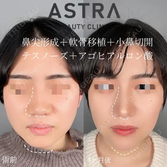 【大変身】隆鼻術・鼻尖形成・軟骨移植・小鼻切開・ヒアルロン酸（顎） after画像 メイン用