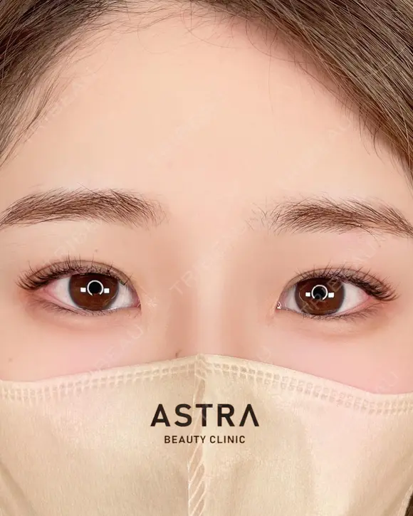 【史上最高の二重へ】スターラインダブル after画像 メイン用