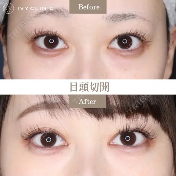 目頭切開 before画像 メイン用