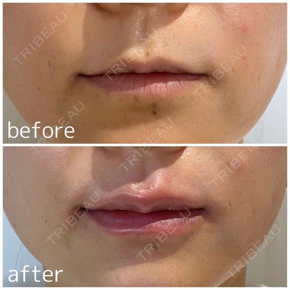 唇ヒアルロン酸 before画像 メイン用
