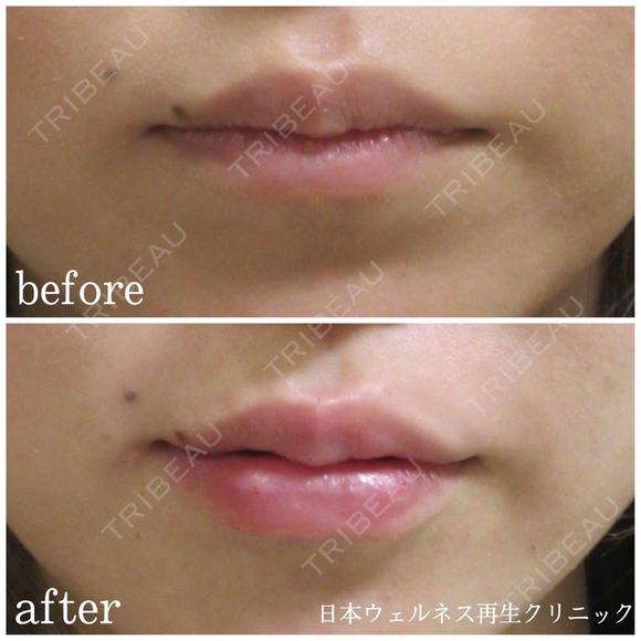 唇ヒアルロン酸 after画像 メイン用