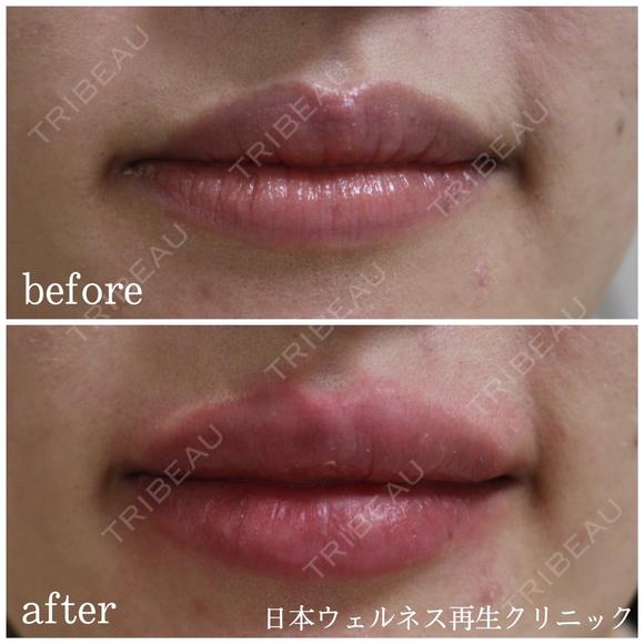 唇ヒアルロン酸注入 after画像 メイン用