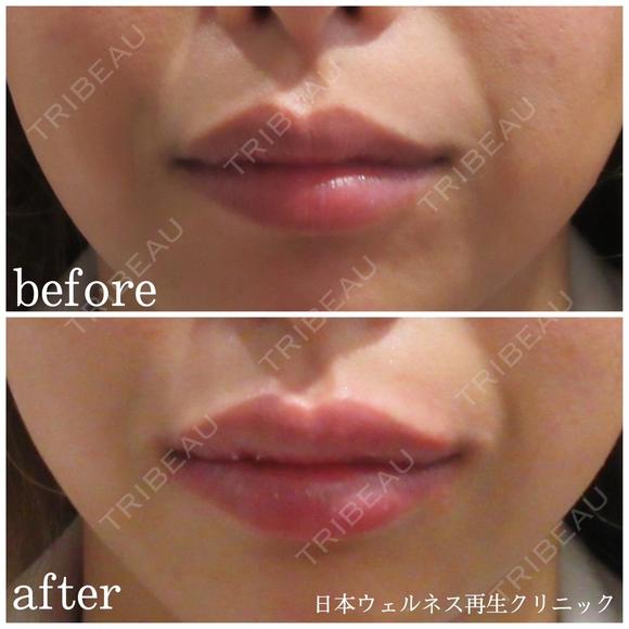 唇ヒアルロン酸 after画像 メイン用