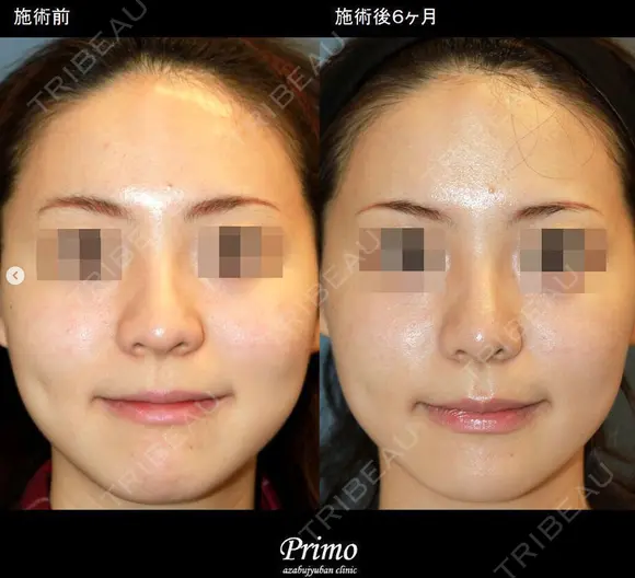 鼻尖縮小術 before画像 メイン用