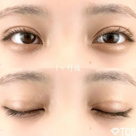 二重埋没法/まぶたの脂肪取り after画像 メイン用