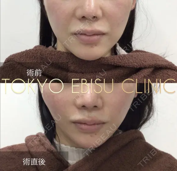 ミドルリフトプラス before画像 メイン用