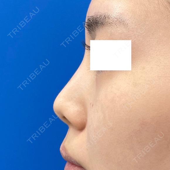 鼻中隔延長＋鼻尖形成3D＋鼻尖部軟骨移植 before画像 メイン用