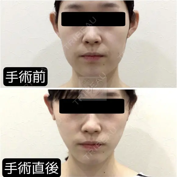 ミニリフト before画像 メイン用