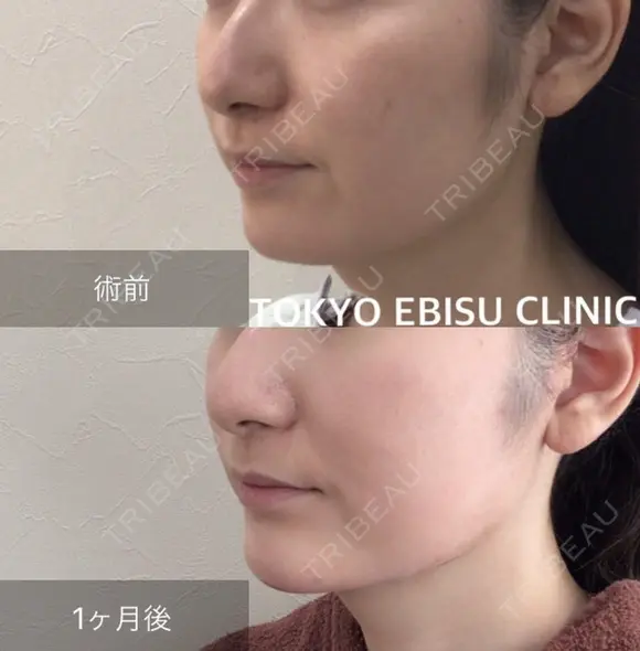 ミドルリフト before画像 メイン用