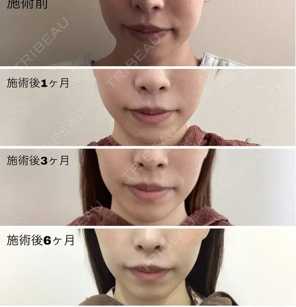 トータルフェイスリフト before画像 メイン用