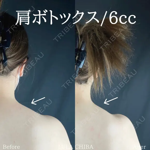 肩ボトックス(６㏄) after画像 メイン用