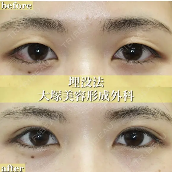 愛され目元の二重術💗 before画像 メイン用