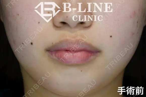 【口唇縮小手術上下】 before画像 メイン用