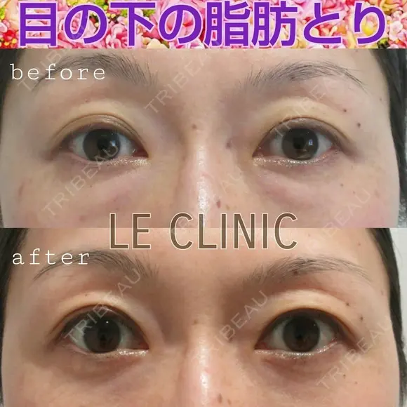 目の下の脂肪取り before画像 メイン用