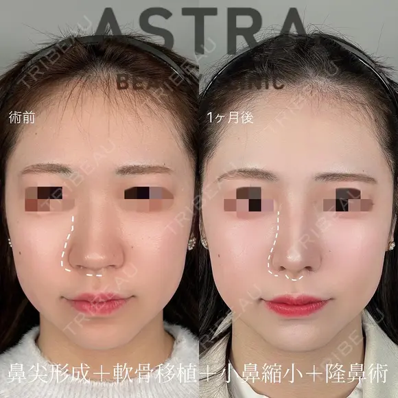 隆鼻術/鼻尖形成/軟骨移植/小鼻縮小 after画像 メイン用