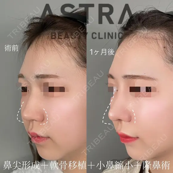 隆鼻術/鼻尖形成/軟骨移植/小鼻縮小 after画像 メイン用